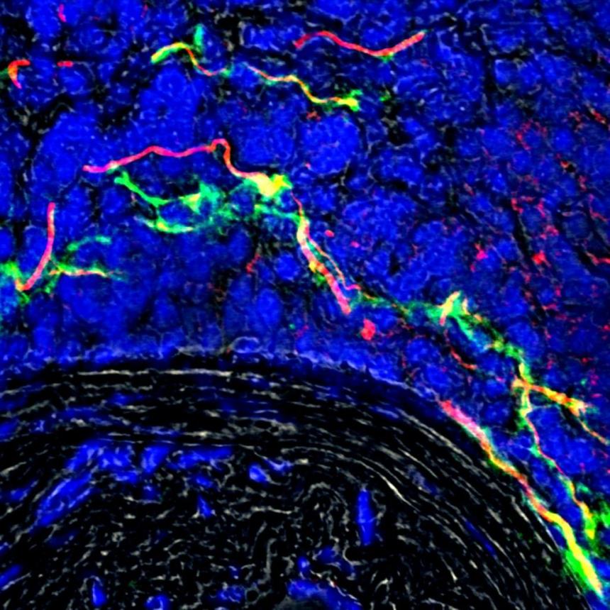 Le placche aterosclerotiche “dialogano” con il cervello 